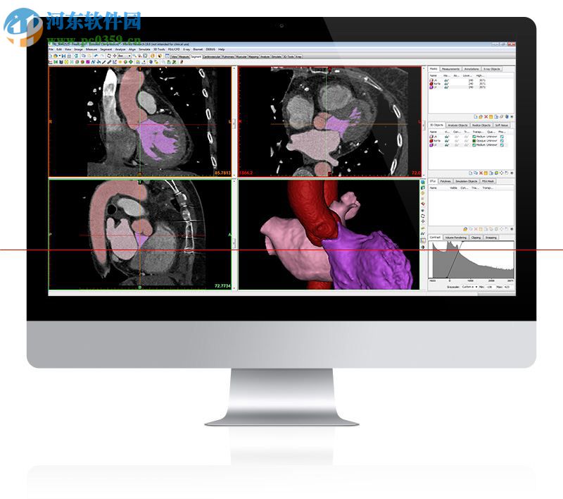 mimics下载 (医学图像处理软件)  附安装教程 17.0 中文破解版