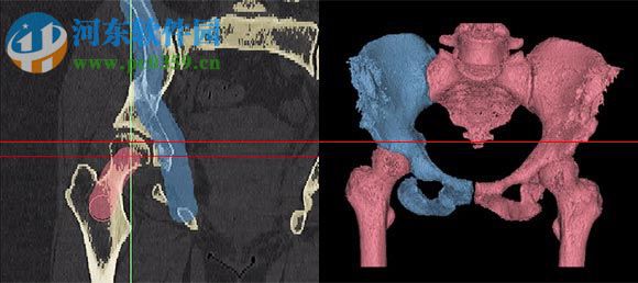 mimics下载 (医学图像处理软件)  附安装教程 17.0 中文破解版